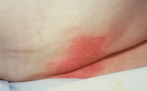 Close up of woman's back showing large areas of red skin