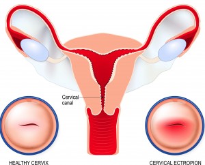 Graphic showing where to cervical canal is located with cross-sections of a healthy cervix and one affected by cervical erosion